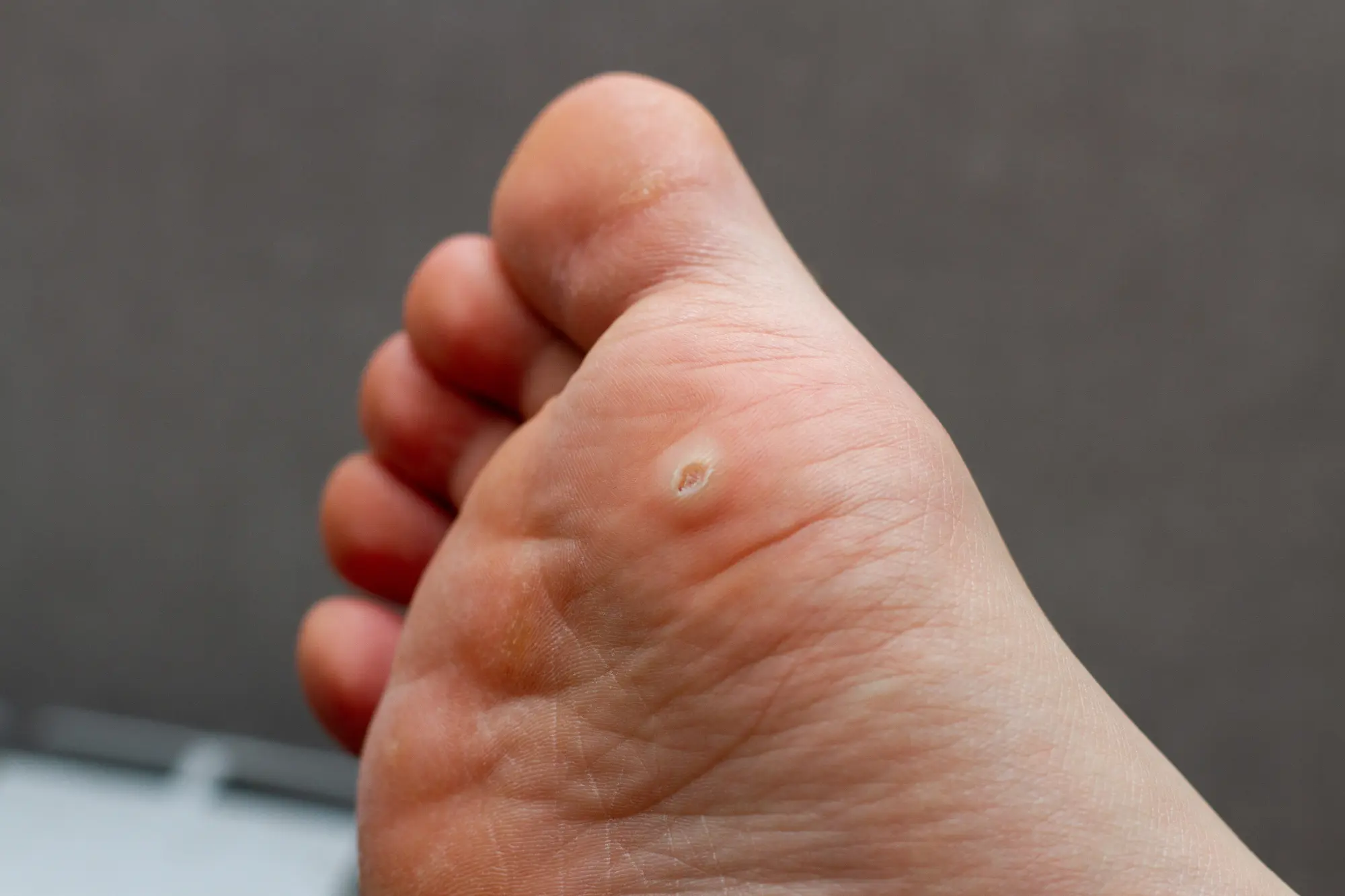 an example of a wart on the foot